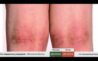Аллергия на коленях и под коленями — как бороться с напастью