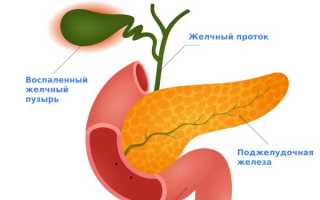 Как эффективно лечить холецистит: советы и рекомендации