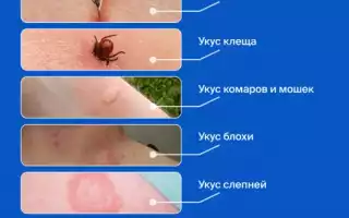 Аллергия на укусы ос, пчел, шмелей и шершней — возможная опасность