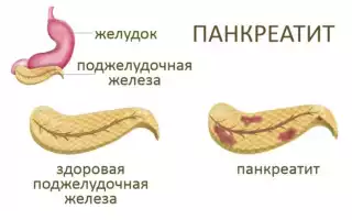Лечение хронического панкреатита: как вернуть здоровье поджелудочной навсегда