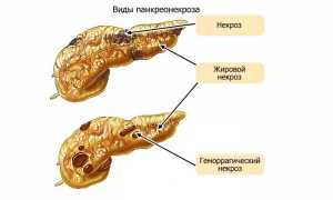 Какие бывают симптомы панкреонекроза поджелудочной железы?