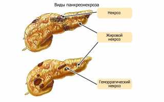 Какие бывают симптомы панкреонекроза поджелудочной железы?