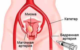 Эмболизация маточных артерий при миоме матки: отзывы