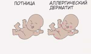 Потница или аллергия — как отличить? Фото и сравнительные таблицы