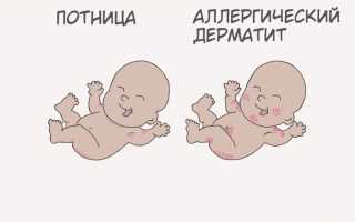 Потница или аллергия — как отличить? Фото и сравнительные таблицы
