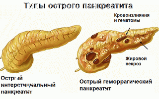 Симптомы и лечение аутоимунного панкреатита