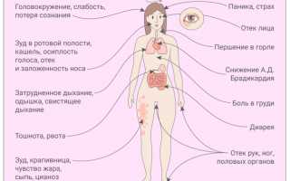 Особенности проявления аллергии на молоко у взрослых и детей