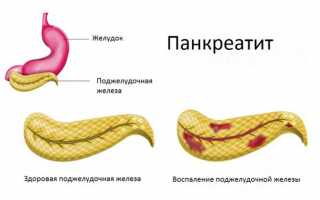 Опасные последствия панкреатита