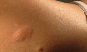 Аллергия на сперму: легкая неприятность или бесплодие?