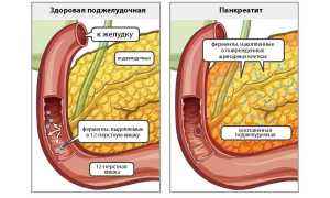Панкреатит поджелудочной железы при беременности: что важно знать