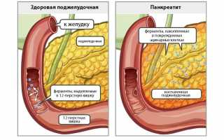 Панкреатит поджелудочной железы при беременности: что важно знать