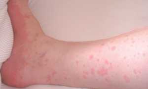 Как проявляется аллергия на кошек у детей и взрослых