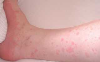 Как проявляется аллергия на кошек у детей и взрослых