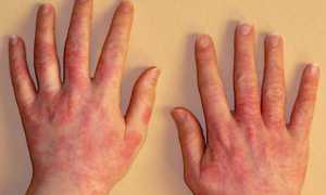 Как проявляется аллергия на арахис — симптомы и фото