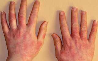 Как проявляется аллергия на арахис — симптомы и фото