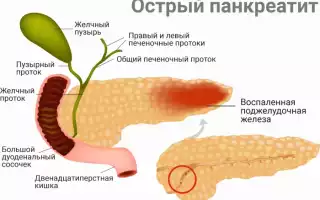 Острый панкреатит: что это такое и как с этим справиться?