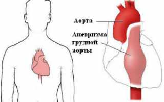Расслоение аорты: симптоматика и лечение
