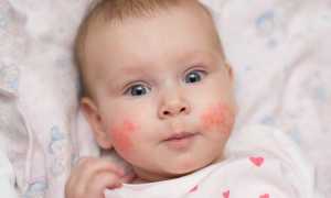 Как проявляется аллергия на сладкое у детей и взрослых