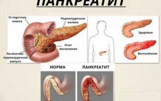Воспаление поджелудочной железы: что нужно знать и как с этим бороться