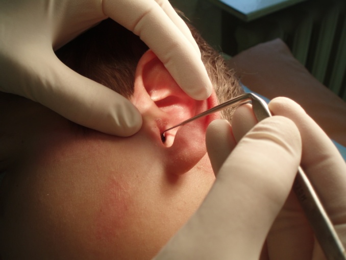 ЛОР сможет извлечь насекомое специальным инструментом