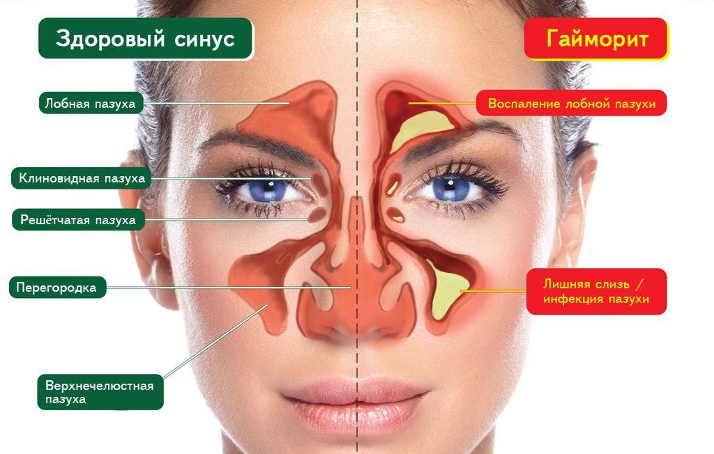 Здоровый синус и гайморит