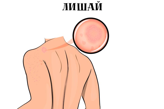 Лишай