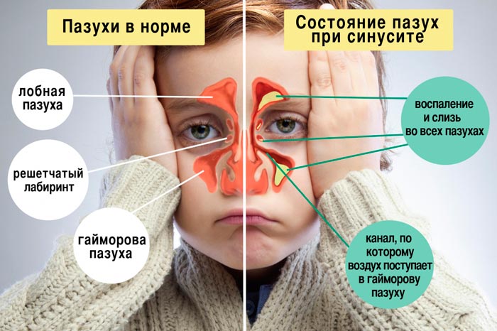 синусит у ребенка