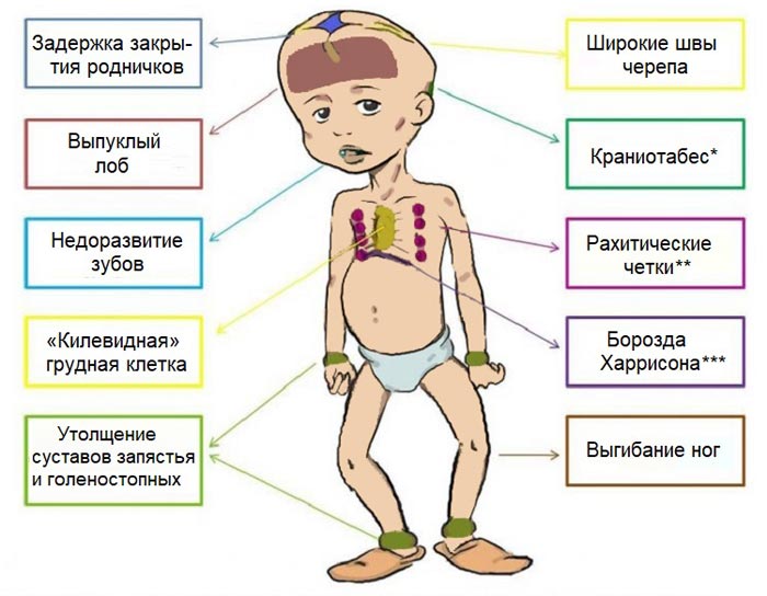 симптомы рахита