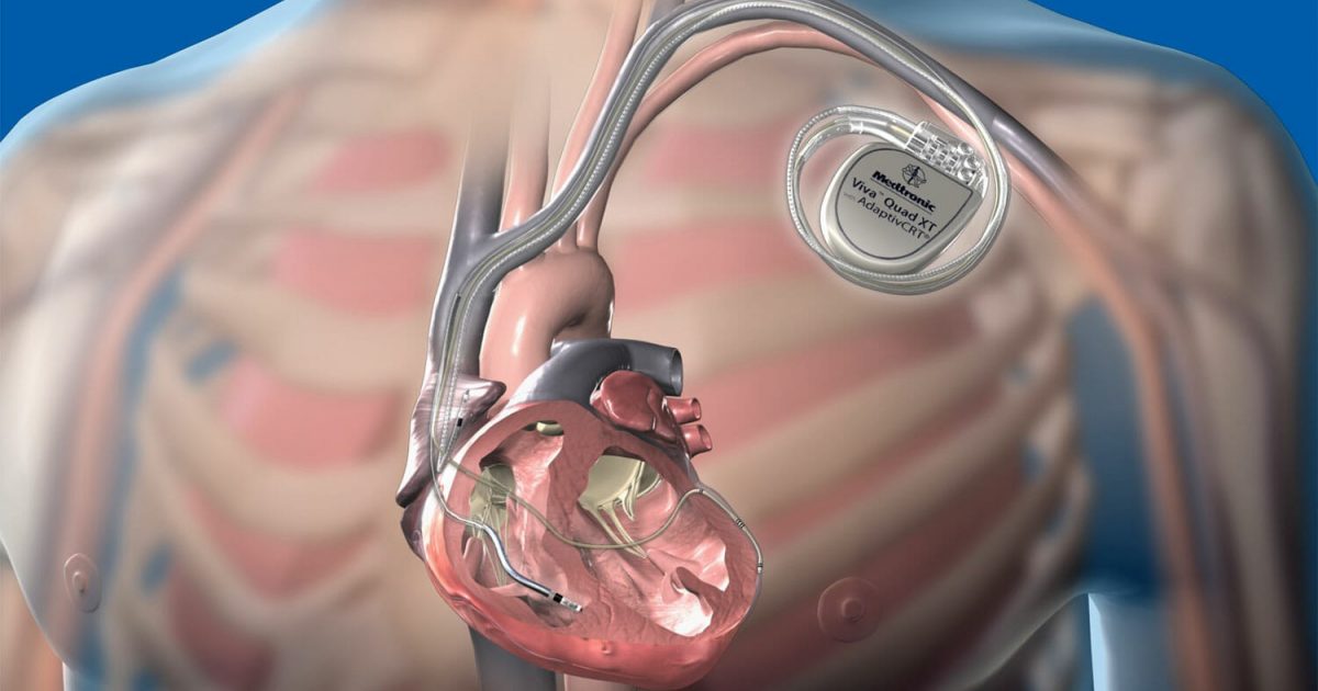 Жизнь с кардиостимулятором: реабилитация, продолжительность жизни, осложнения