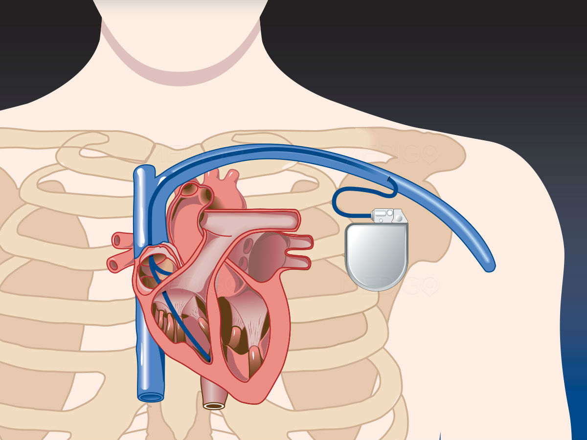 куда устанавливают кардиостимулятор