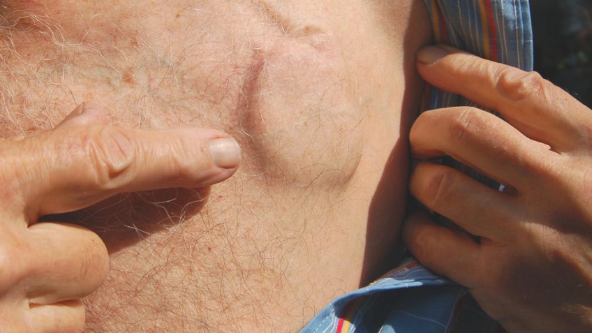 кардиостимулятор в теле человека