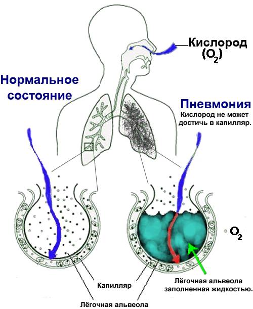 pnevmoniya