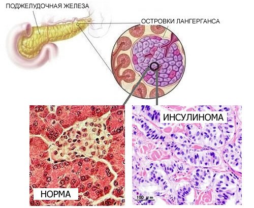 insulinoma