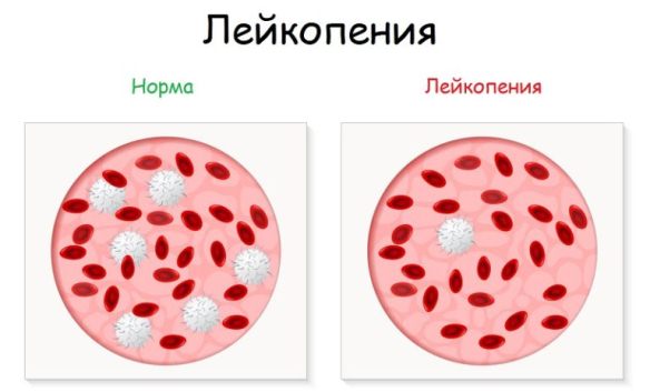 leykopeniya