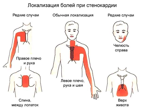 lokalizacija boli pri stenokardi