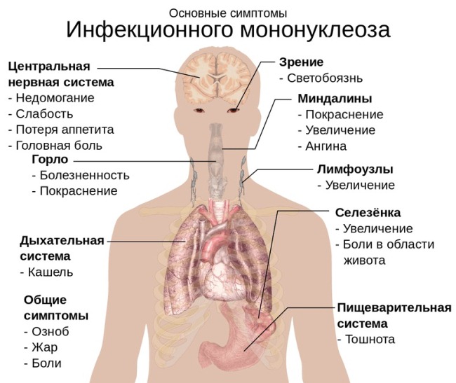 mononucleos simptomy