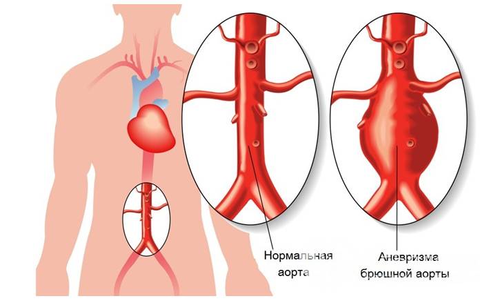 Расслаивающая аневризма аорты