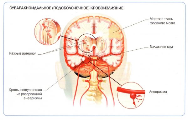 Как выглядит субарахноидальное кровоизлияние головного мозга