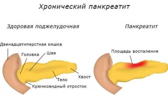 Если заболевание приобрело хронический характер, то назначенная врачом диета направлена на предотвращение повторных обострений, которые могут повлиять на почки и другие органы человека