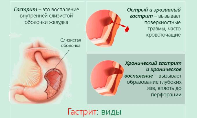 Гастриты и язвы - частые спутники панкреатит