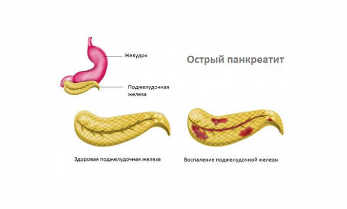 При острой форме панкреатита применять куркуму запрещено