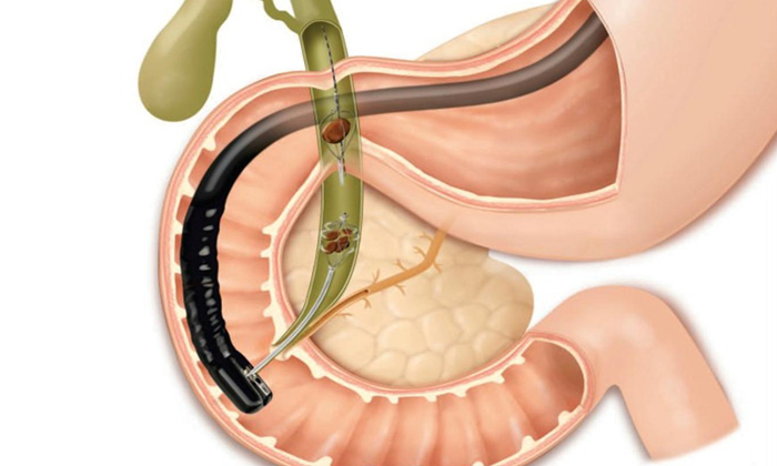 С осторожностью масло используют при желчнокаменной болезни
