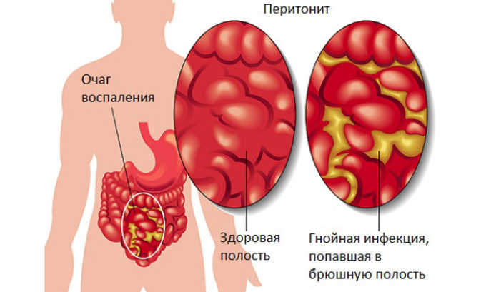 После операции возможен перитонит