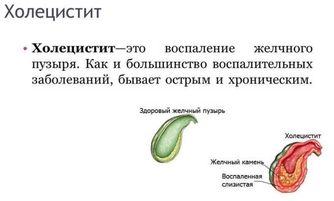 После панкреатита часто страдает желчный пузырь и развивается холецистит