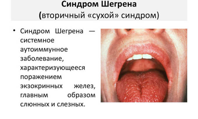 К провоцирующим факторам относится синдром Шегрена