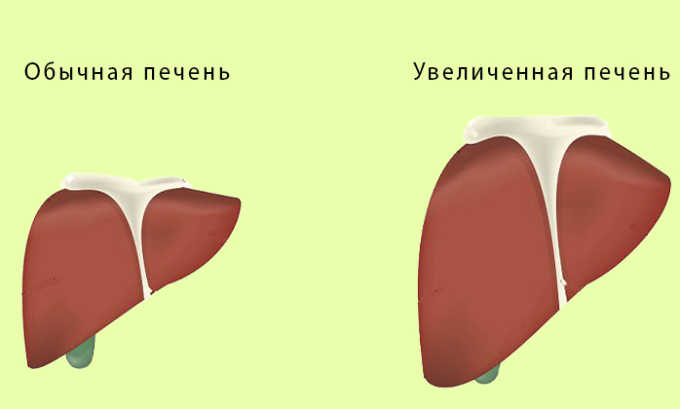Главными аспектами терапии является нормализация состояния печени