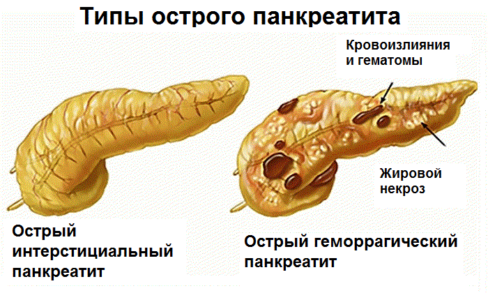 Самым опасным последствие панкреатита является развитие некроза и злокачественное перерождение клеток