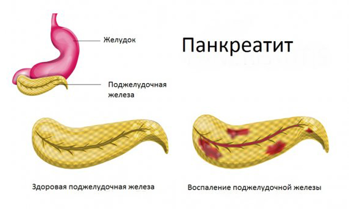 Воспаление - это распространенное поражение органа